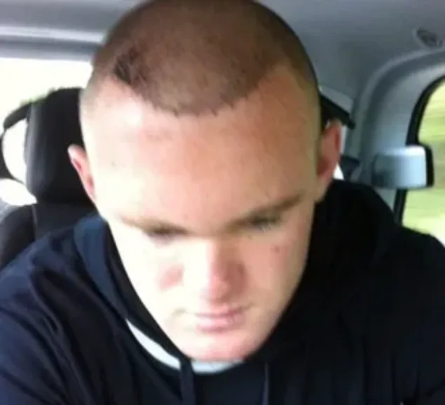 Spex hair the truth about hair loss and hair transplants Image