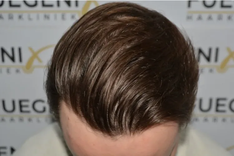 After hair transplant pic