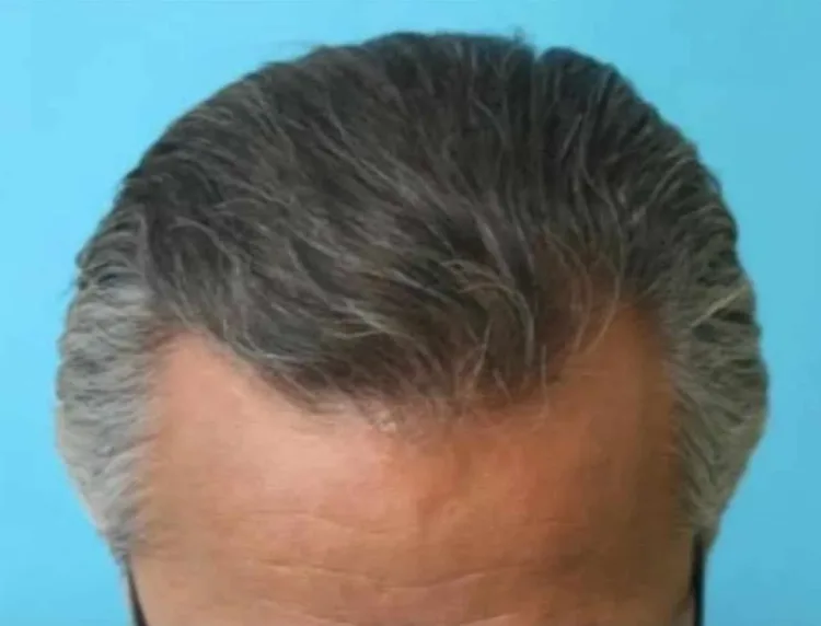 Dr Scott After Hair Transplant