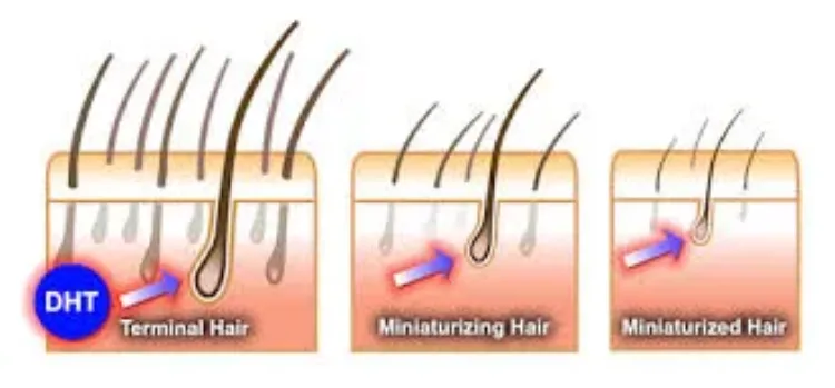 male-pattern-baldness
