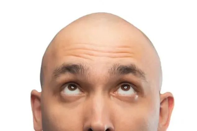 Is Calling Someone “Bald” Now Sexual Harassment? Image
