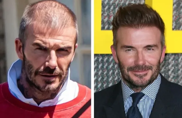 David Beckham Hair: Hair Loss, Hair Transplants and Modern Hair Restoration Image