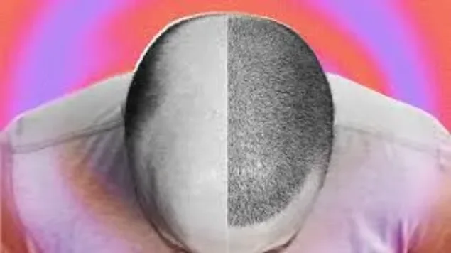 Everything You Should Know Before Getting a Hair Transplant Image