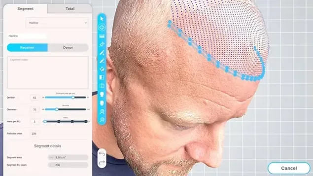 ForceHT and the Future of Ethical Hair Transplant Consultations Image
